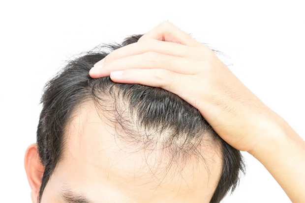 hairfall problems and solutions